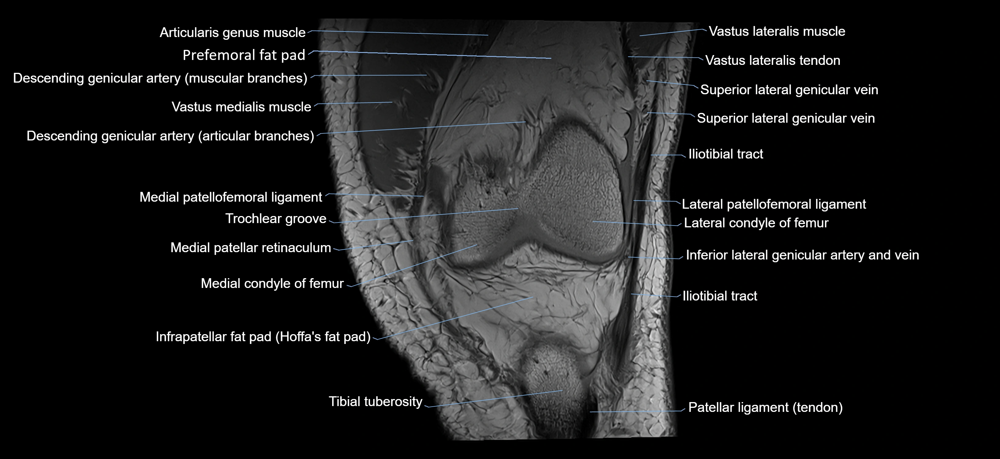 MRI knee coronal cross sectional anatomy labelled 3T radiology  image-04001-00011.webp